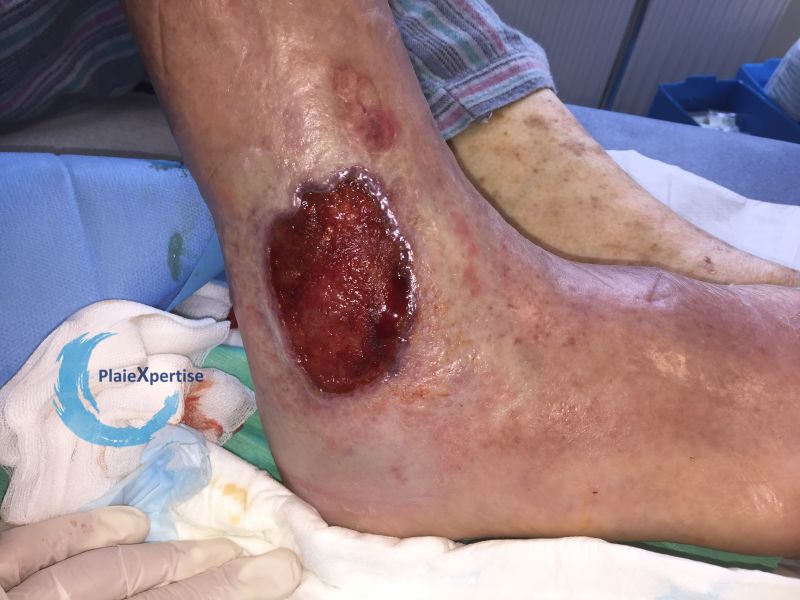 Fichier:Tissu de granulation inflammatoire44.jpg