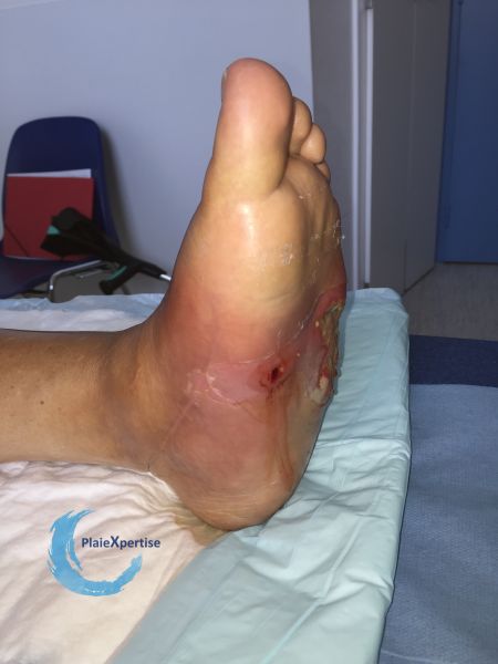 Fichier:Pied de Charcot29.jpg