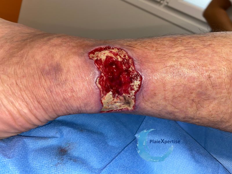 Fichier:Tissu de granulation inflammatoire41.jpg