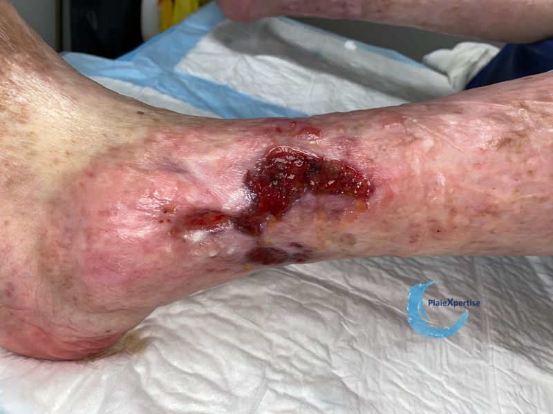 Fichier:Tissu de granulation inflammatoire50.jpg
