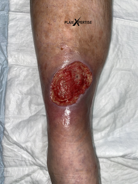 Fichier:Tissu de granulation normal27.png