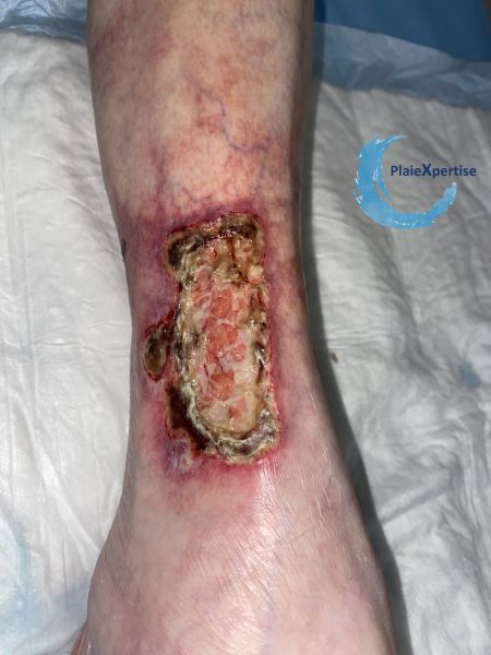 Fichier:Angiodermite typique90.jpg