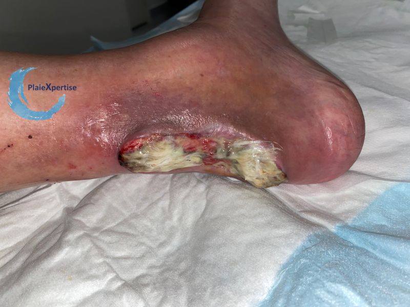 Fichier:Tendon nécrotique humide52.jpg