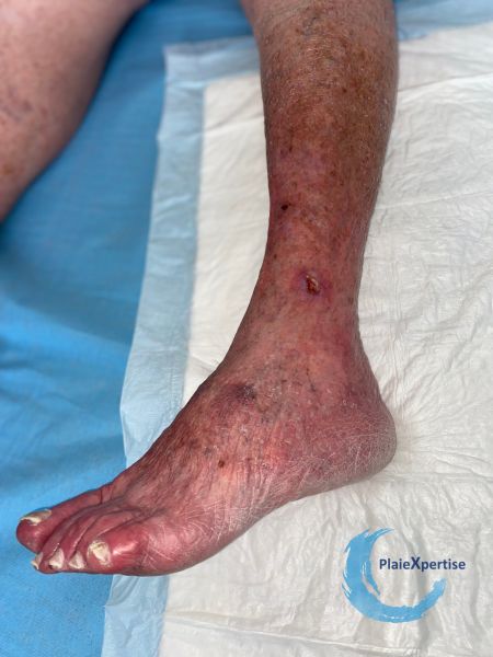 Fichier:Erythrocyanose21.jpg
