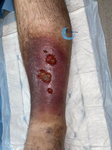 Fichier:Hypodermite chronique54.jpg