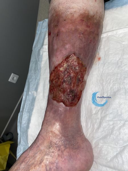 Fichier:Tissu de granulation inflammatoire52.jpg