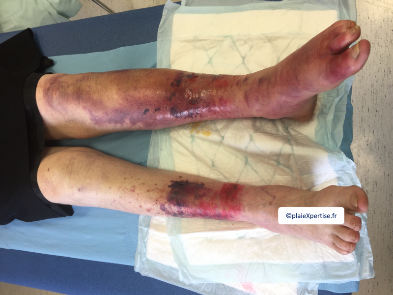 Fichier:Dermatoporose1.png