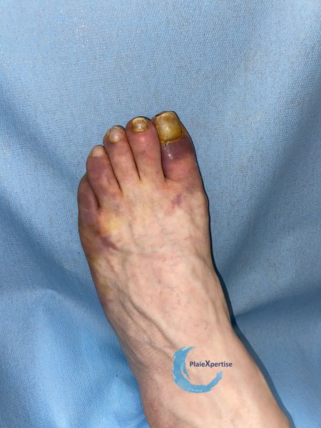 Fichier:Embols de cristaux de cholestérol9.jpg