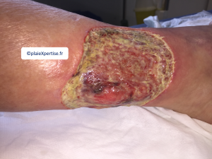 Tendon-Voussure11.png