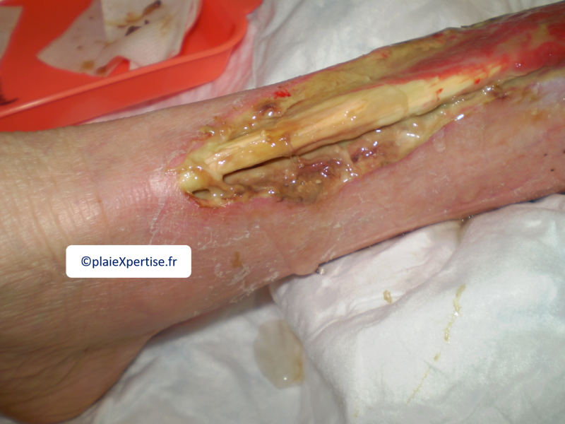 Fichier:Tendon nécrotique humide29.png