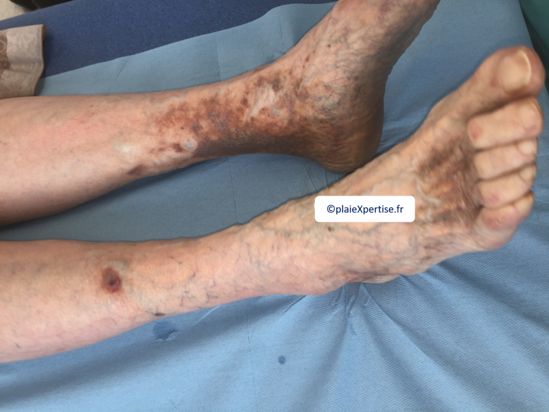 Fichier:Dermiteocre6.png