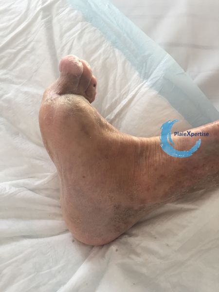 Fichier:Pied de Charcot14.jpg