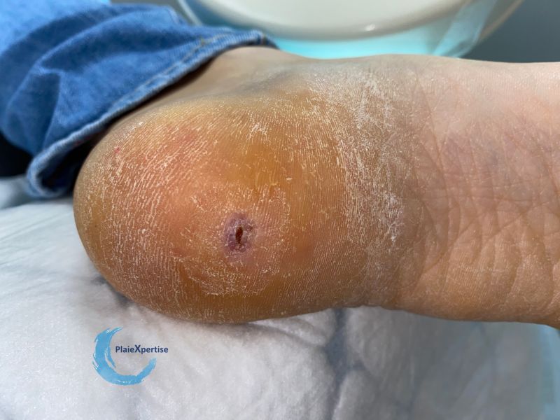 Fichier:Porocarcinome2.jpg