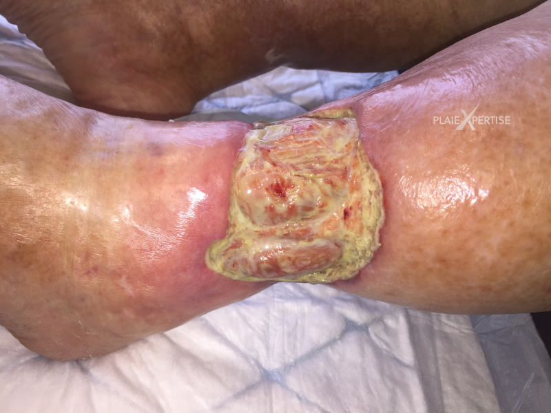 Fichier:Tendon-Voussure13.png