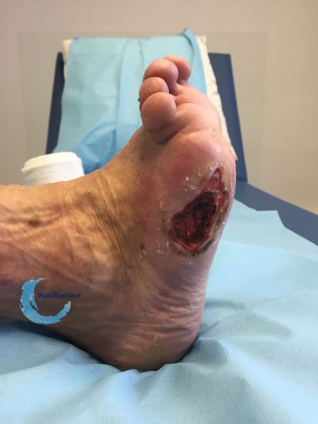 Fichier:Pied déformé8.jpg