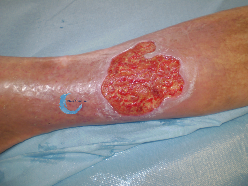 Fichier:Tissu de granulation normal43.png
