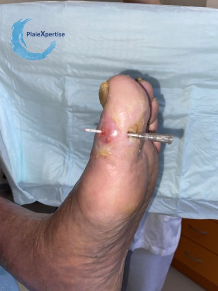 Fichier:Plaies transfixiantes13.jpg