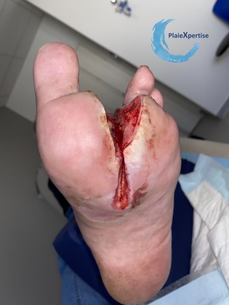 Fichier:Amputation64.jpg