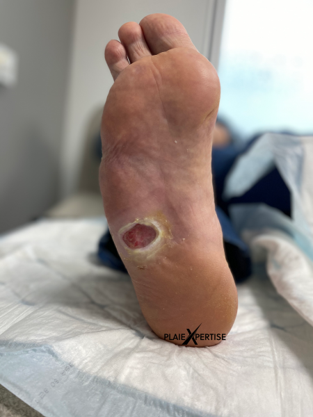 Fichier:Pied de Charcot4.png