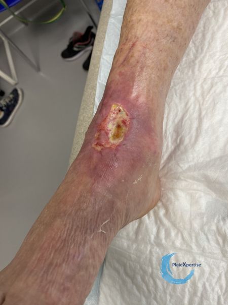 Fichier:Cou de pied75.jpg