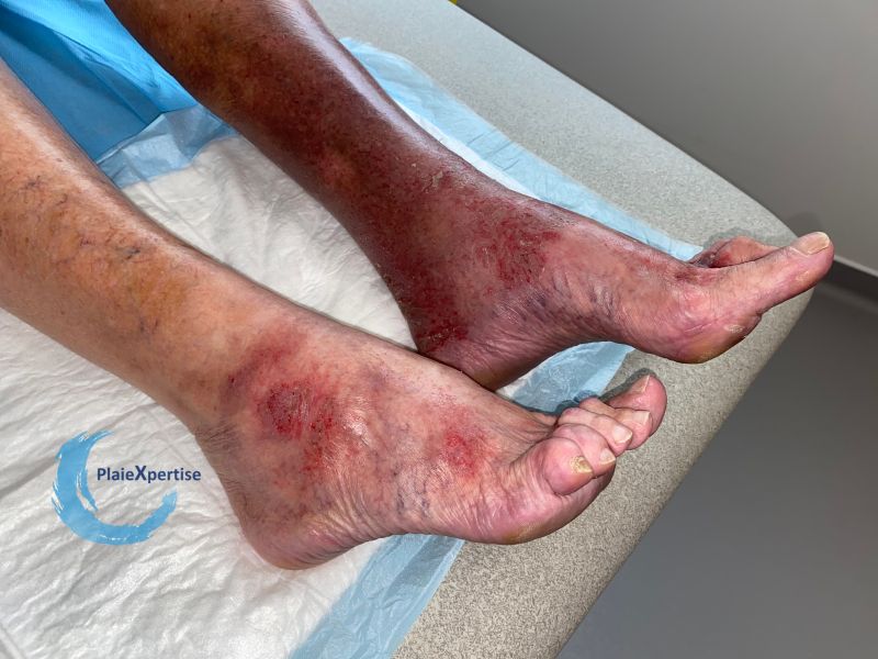Fichier:Eczéma99.jpg