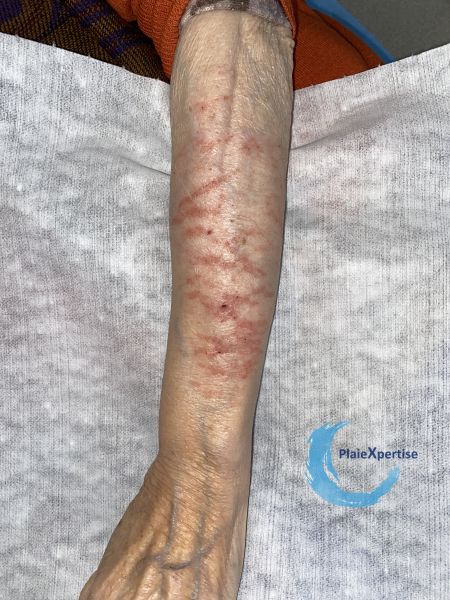 Fichier:Eczéma craquelé30.jpg