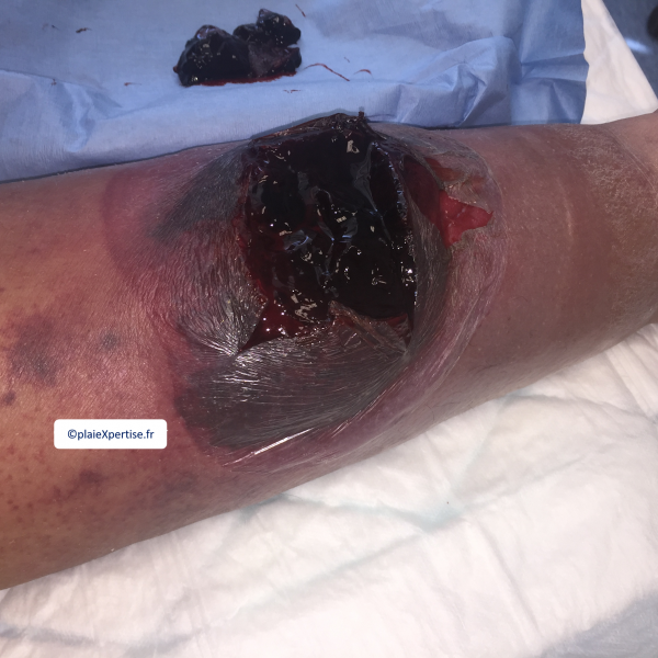 Fichier:HD-Cas clinique 14.png