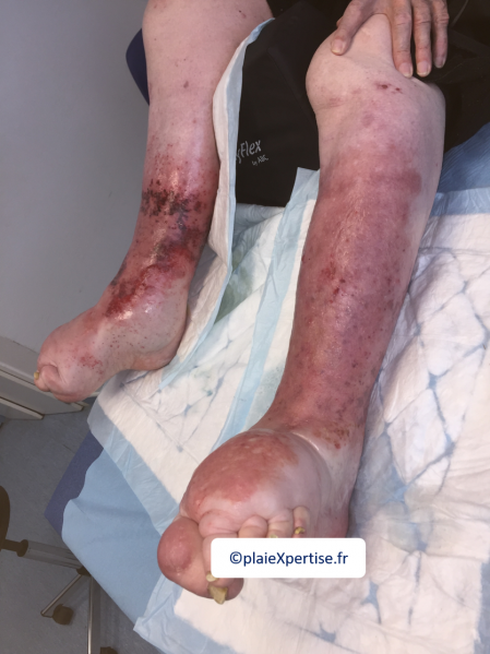 Fichier:Lymphoedème4.png