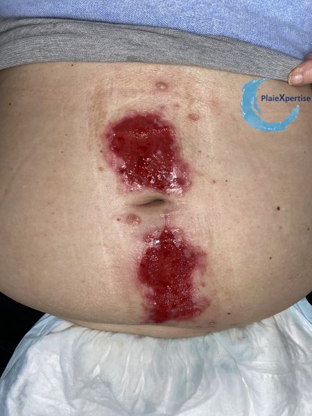 Fichier:Pyoderma gangrenosum37.jpg