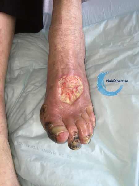 Fichier:Cou de pied66.jpg