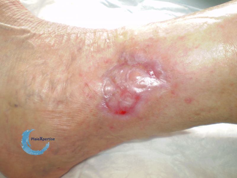 Fichier:Epidermisation9.jpg