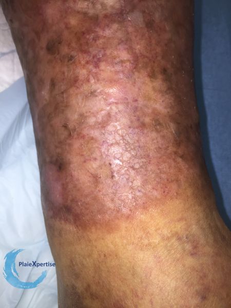 Fichier:Nécrobiose lipoïdique17.jpg