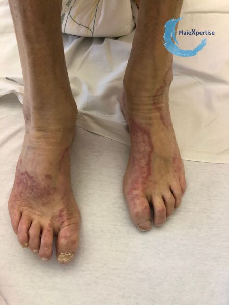Fichier:Dermatophytie1.jpg