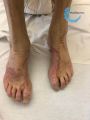 Dermatophytie1.jpg