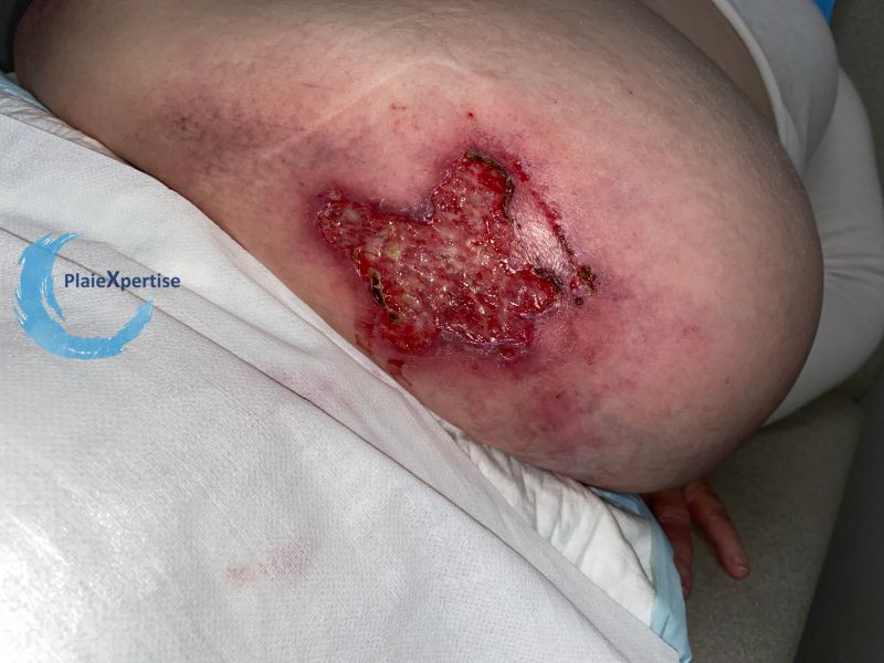 Fichier:Calciphylaxie14.jpg