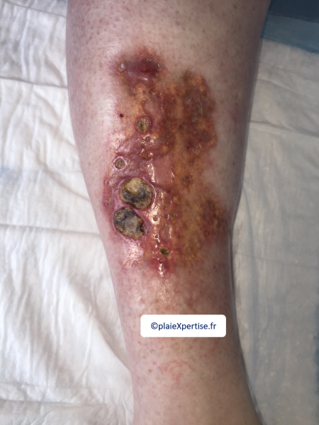 Fichier:Nécrobiose lipoïdique1.png