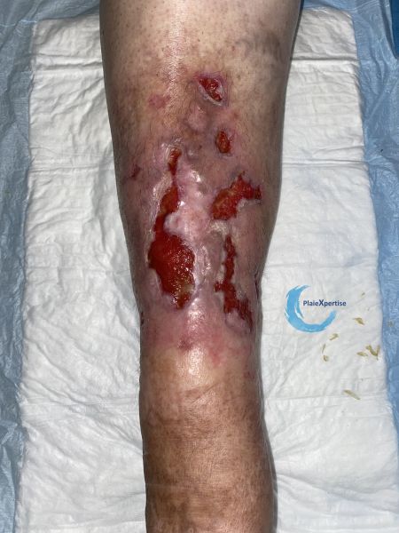 Fichier:Tissu de granulation normal69.jpg