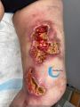 Clciphylaxie 26.jpg