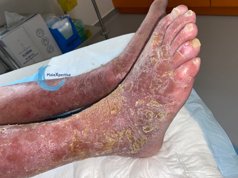 Fichier:Eczéma85.jpg