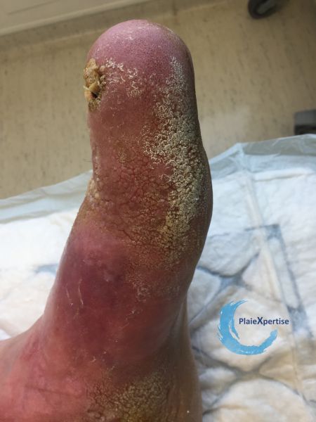 Fichier:Lymphoedème48.jpg