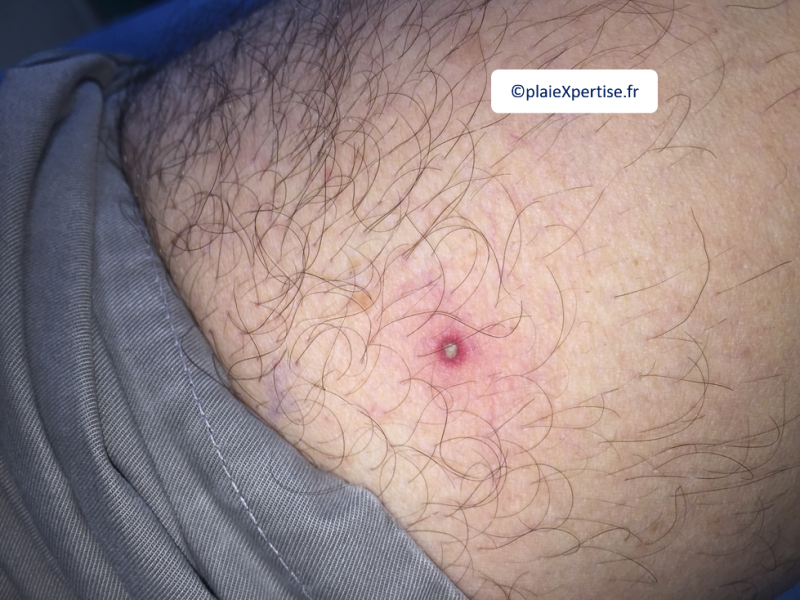 Fichier:Pustules1.png