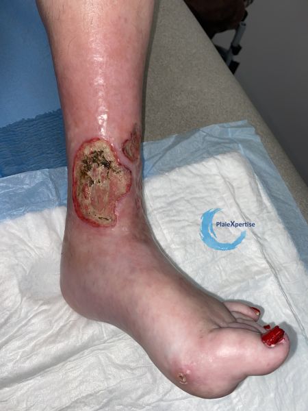 Fichier:Ulcère artériel ou mixte27.jpg