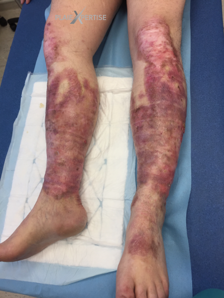 Fichier:Epidermolyse bulleuse acquise1.png
