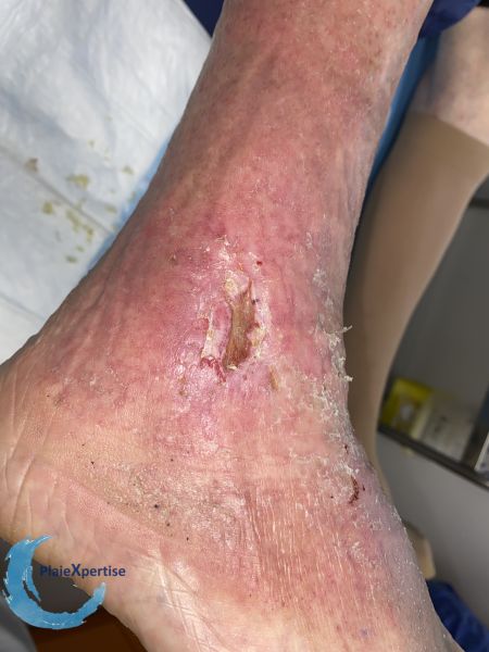 Fichier:Ulcère scléreux105.jpg