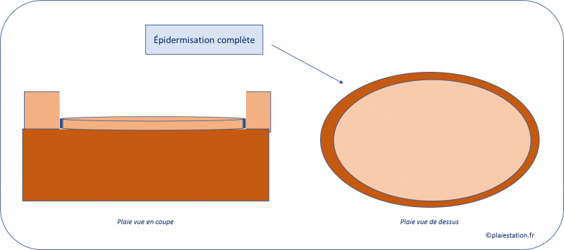 Fichier:8. Epidermisation complète.png