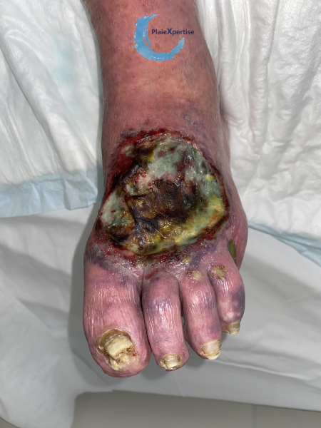 Fichier:Cou de pied59.png