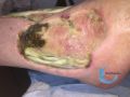 Tendon nécrotique humide67.jpg