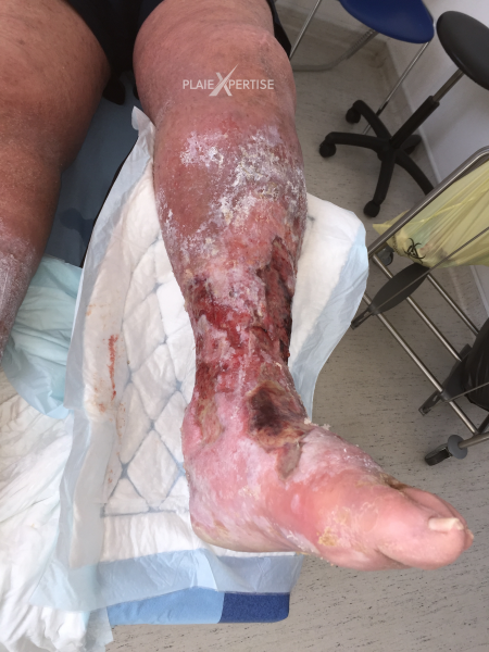 Fichier:Grosses jambes suintantes23.png