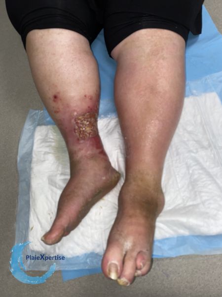 Fichier:Pyoderma gangrenosum62.jpg