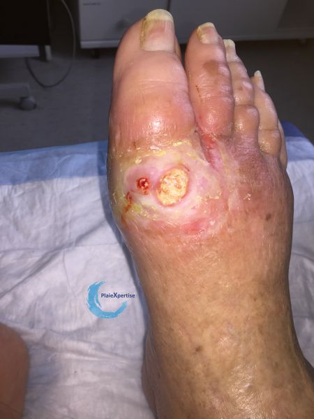 Fichier:Pied goutteux4.jpg